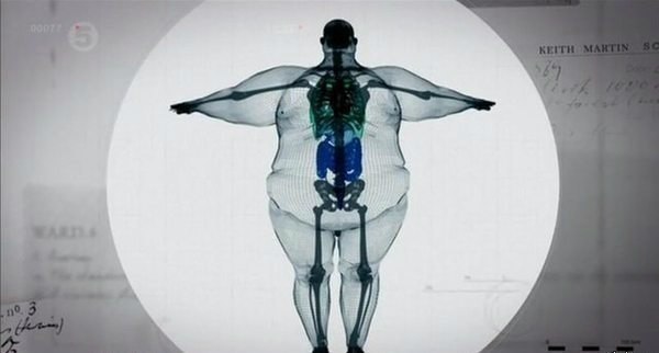 Рентген толстого человека....